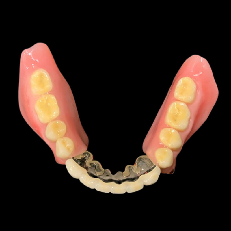 アタッチメント義歯（部分入れ歯 ）