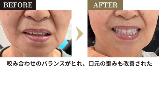 Amazon.co.jp: み 上総義歯 歯科 総義歯 サンプル 見本 入れ歯